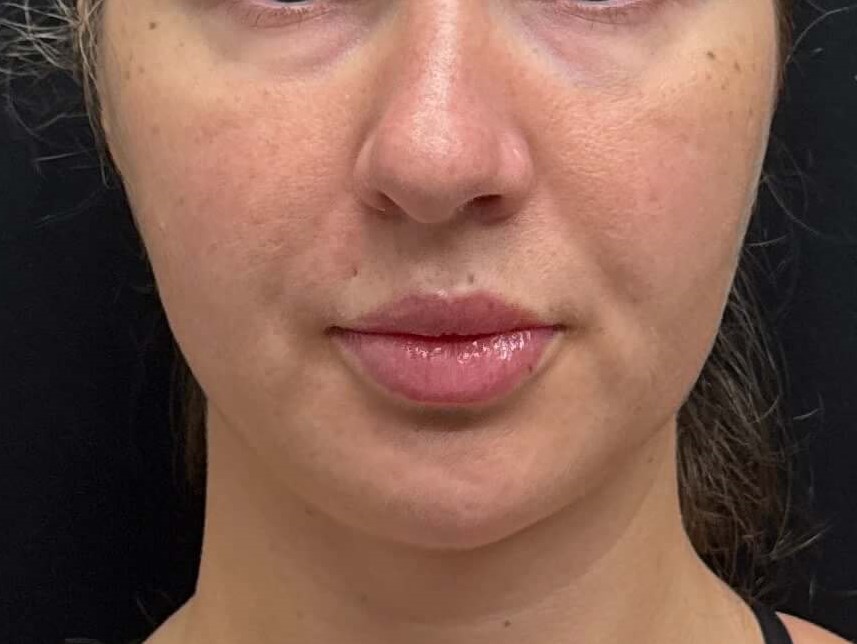 Chin lipo with fat transfer Before Chin lipo with fat transfer Before