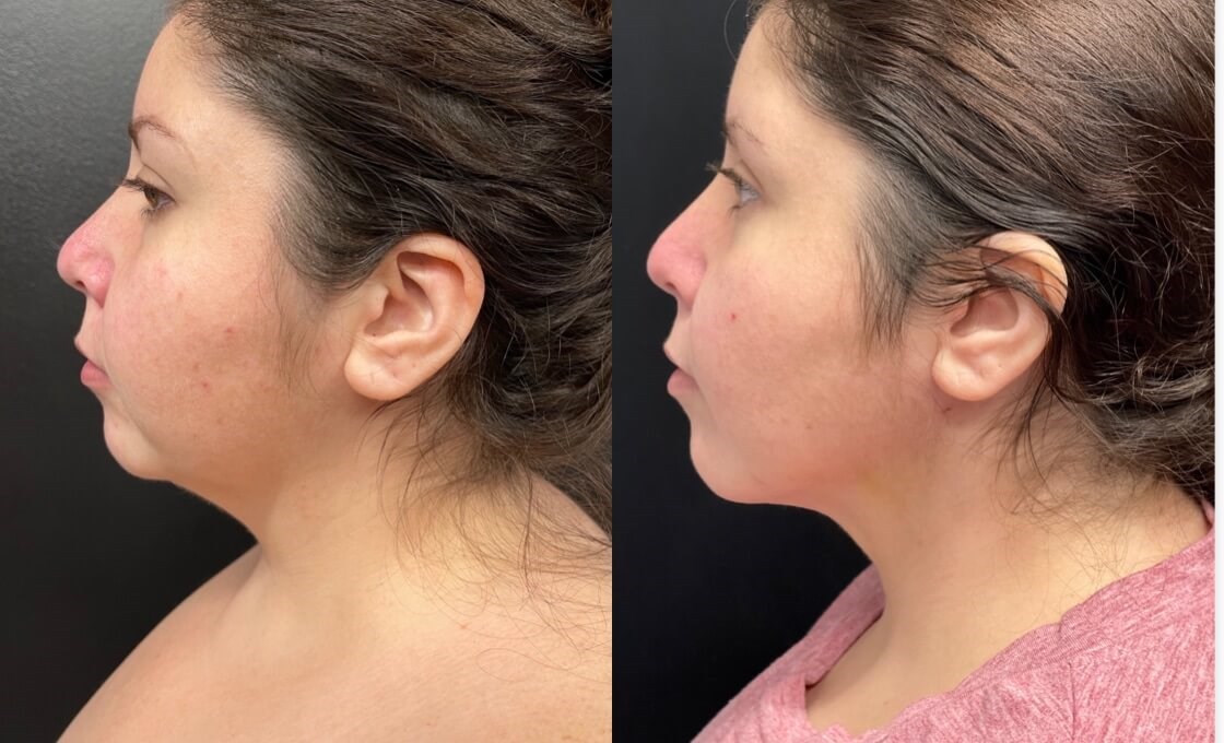Chin and neck liposuction Before