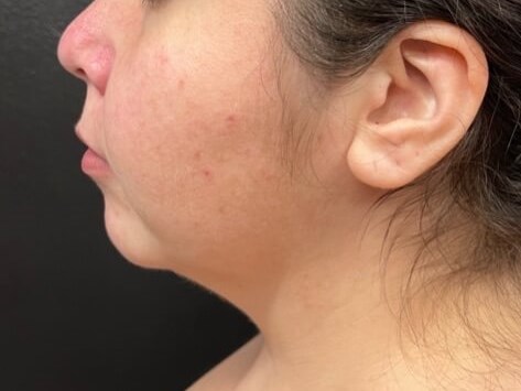 Chin and neck liposuction Before