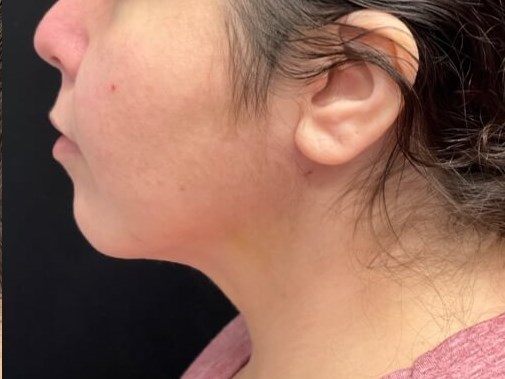 Chin and neck liposuction After