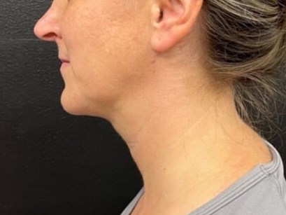 Chin and neck liposuction After