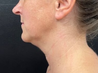 Chin and neck liposuction Before