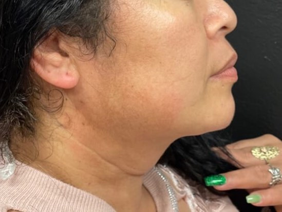 Chin and neck liposuction After