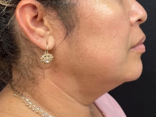 Chin and neck liposuction Before