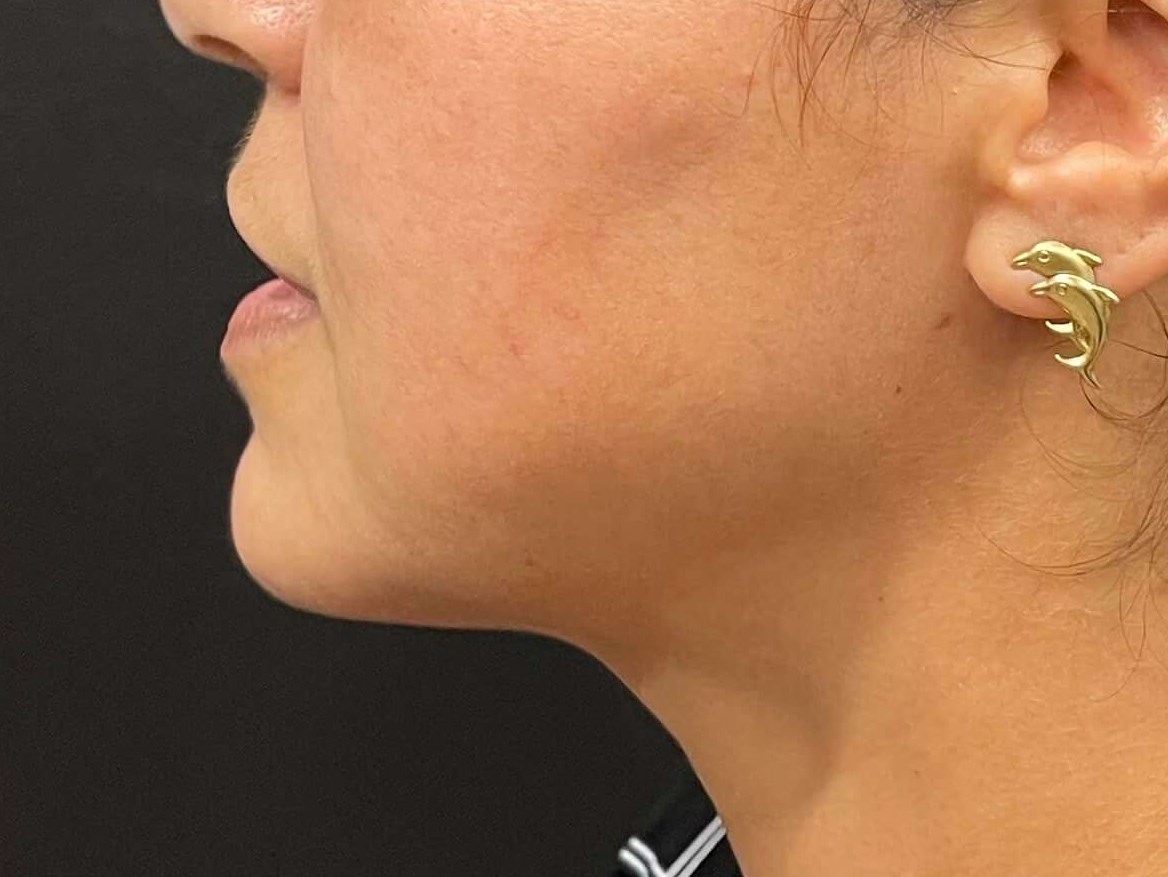 Chin and neck liposuction After