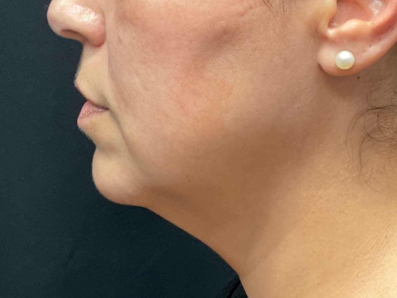 Chin and neck liposuction Before