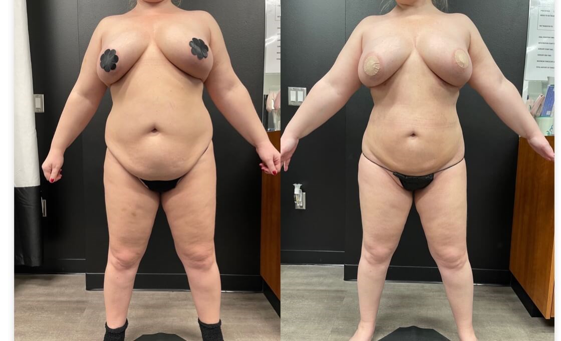 abdominal laser liposuction Before