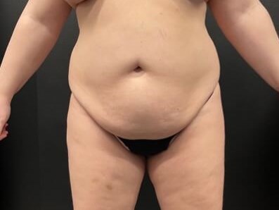 abdominal laser liposuction Before