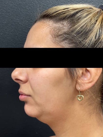 Chin, neck and jawline lipo Before