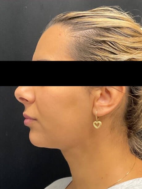 Chin, neck and jawline lipo After