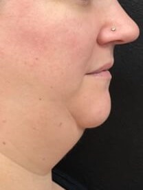 Small Procedure Big Impact Before