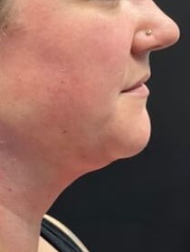 Small Procedure Big Impact After