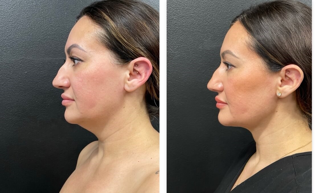 Chin lipo with skin tightening Before