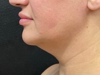 Chin lipo with skin tightening Before