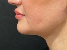 Chin lipo with skin tightening After
