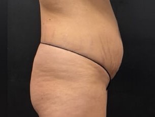 Body transformation Before