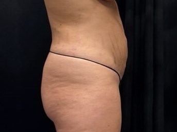 Body transformation After