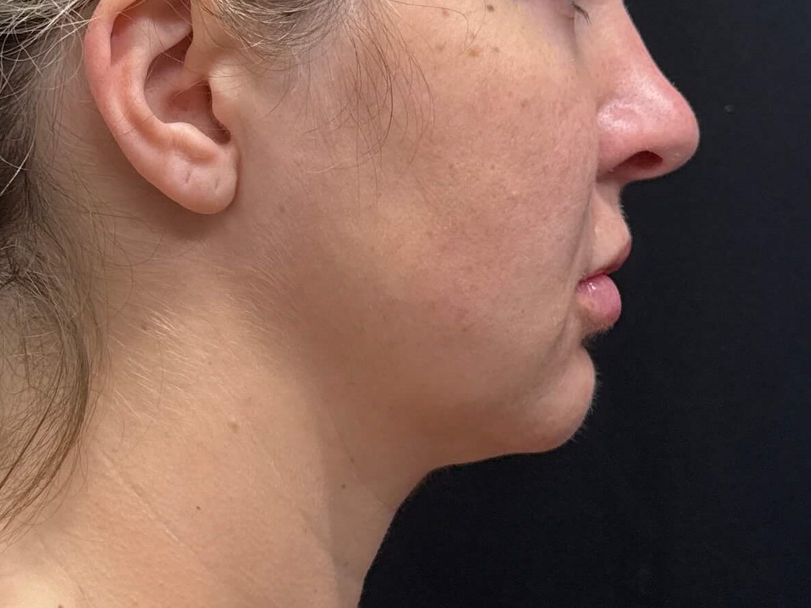 Chin lipo with fat transfer Before