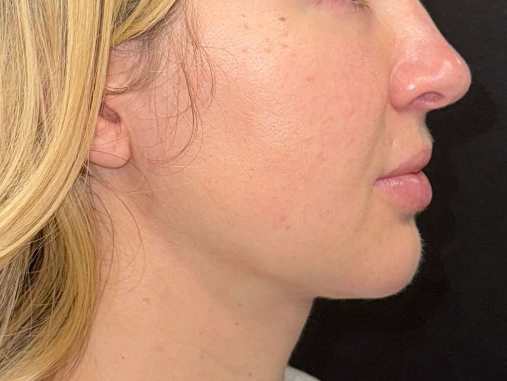 Chin lipo with fat transfer After