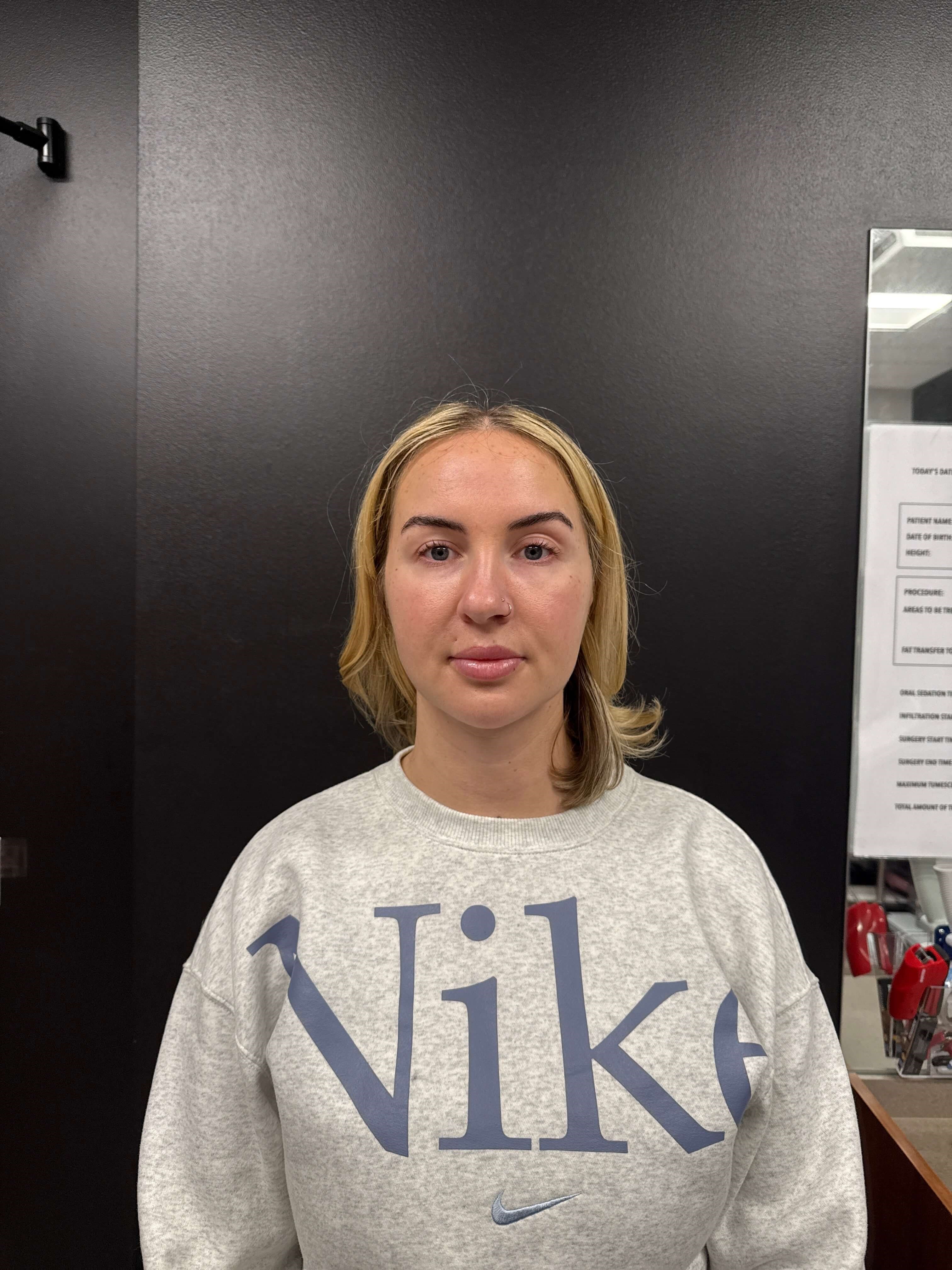 Chin lipo with fat transfer After