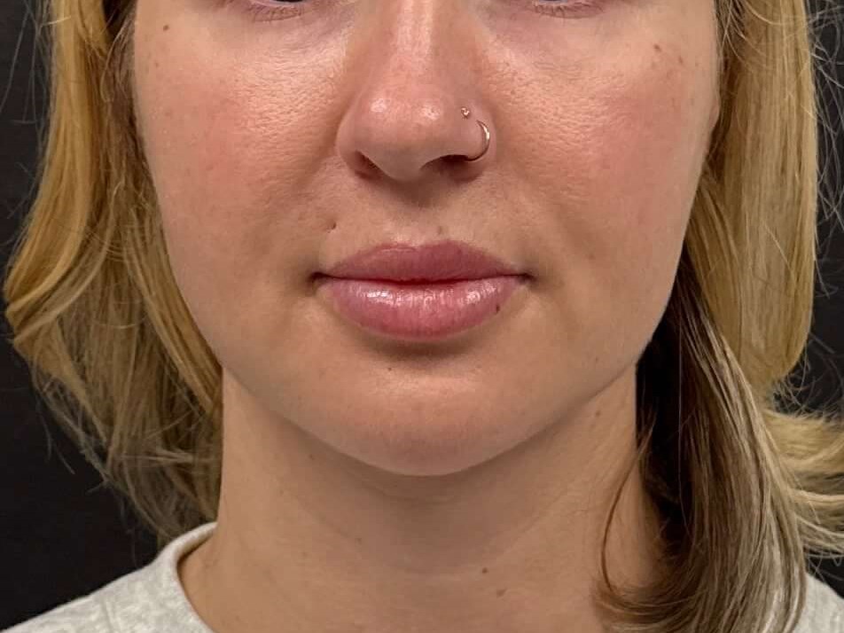 Chin lipo with fat transfer After