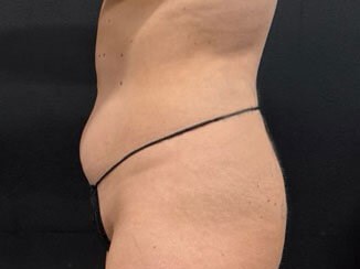 Midsection makeover with lipo Before