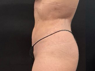 Midsection makeover with lipo After