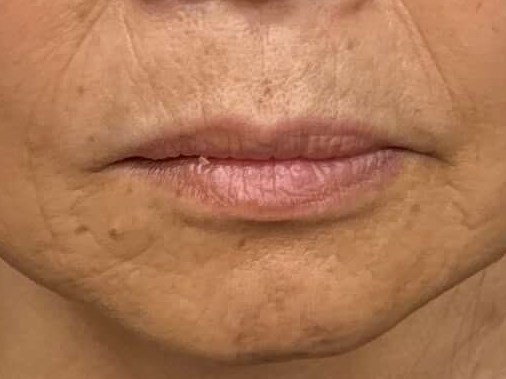 smoothing lines Before