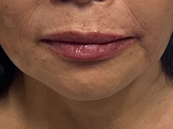 smoothing lines After