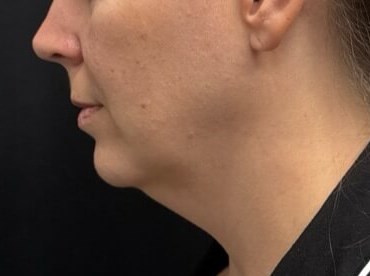 Chin Liposuction Before