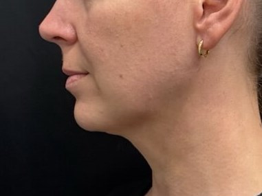 Chin Liposuction After