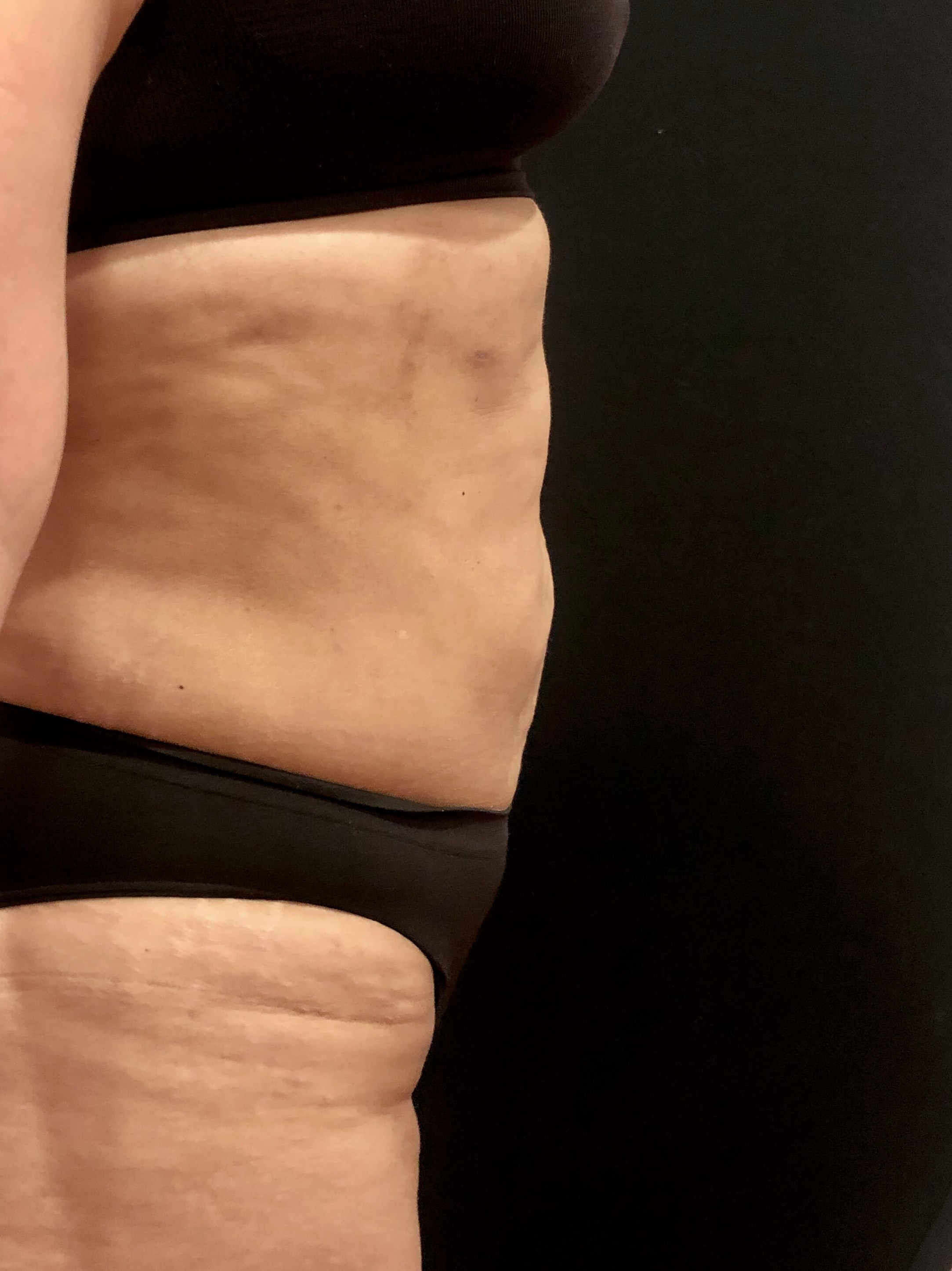 Abdominal Lipo After