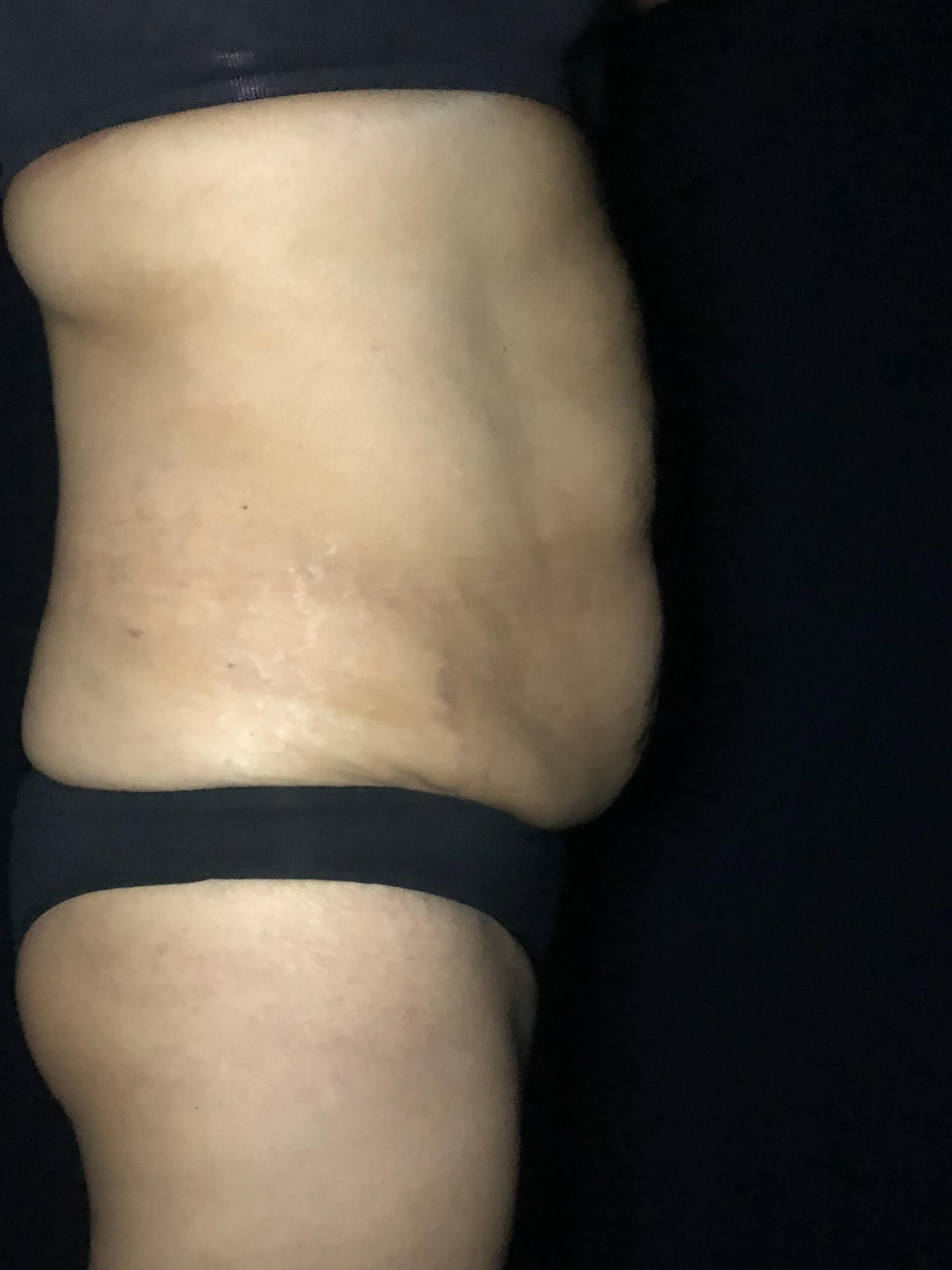Abdominal Lipo Before