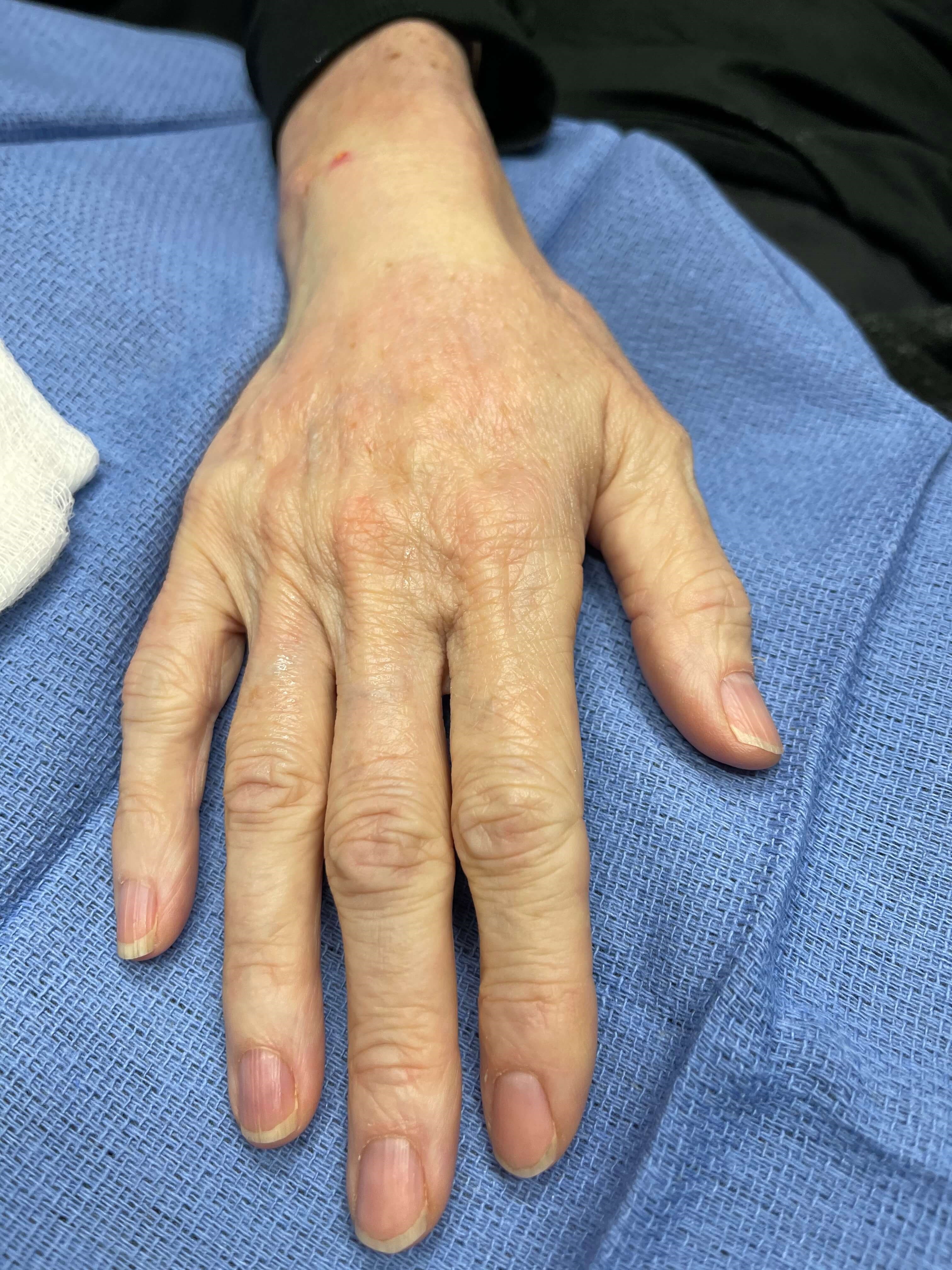 Fat Transfer to Hands Before