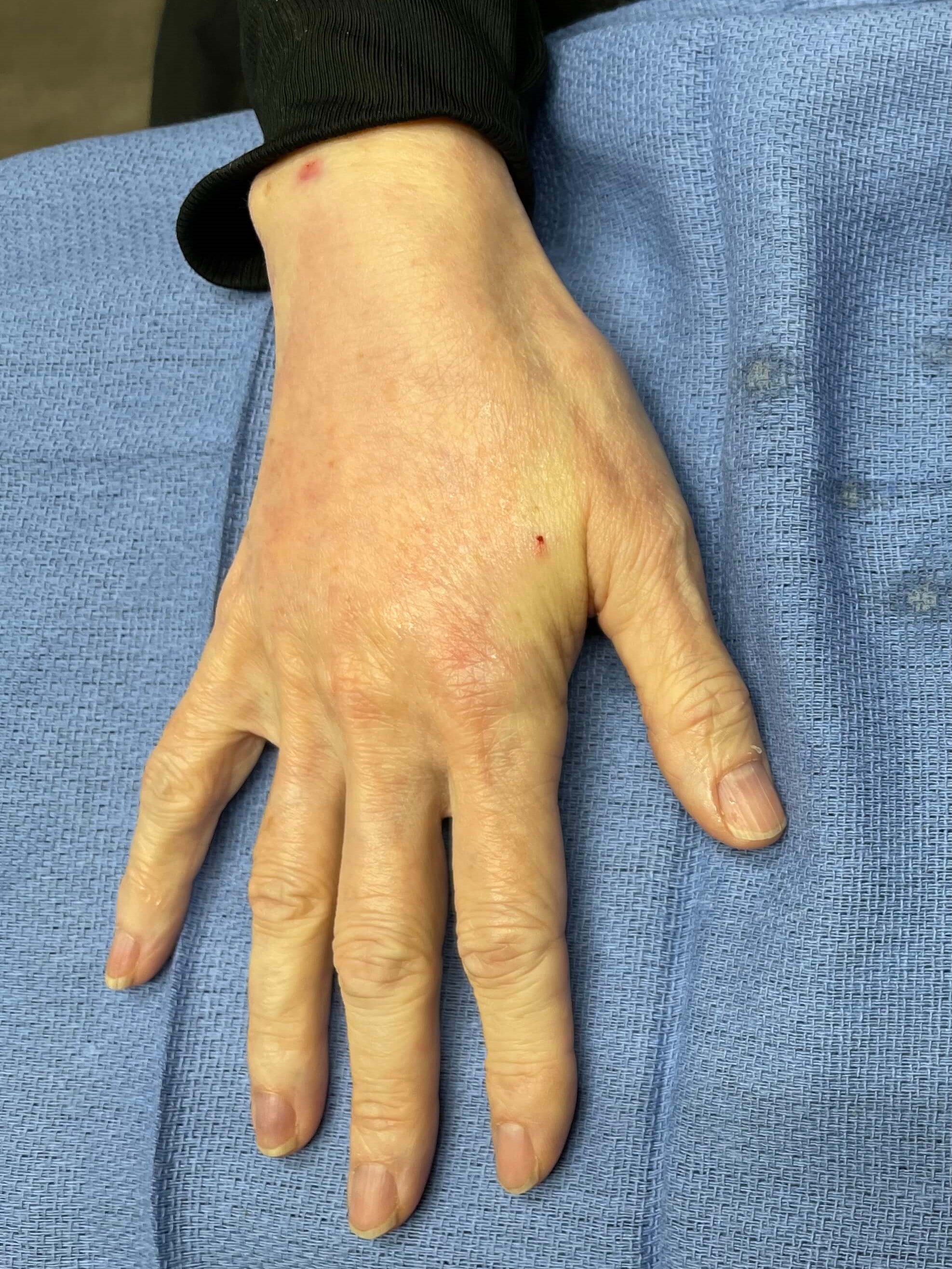 Fat Transfer to Hands After