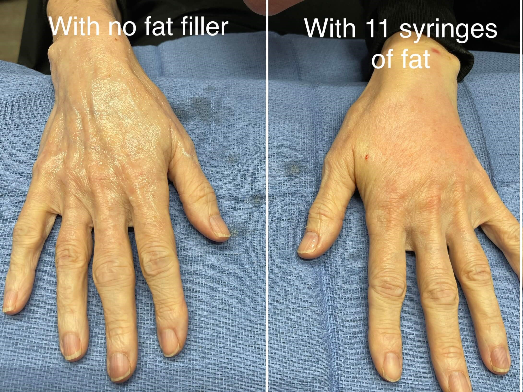 Side by side of fat to hands Before