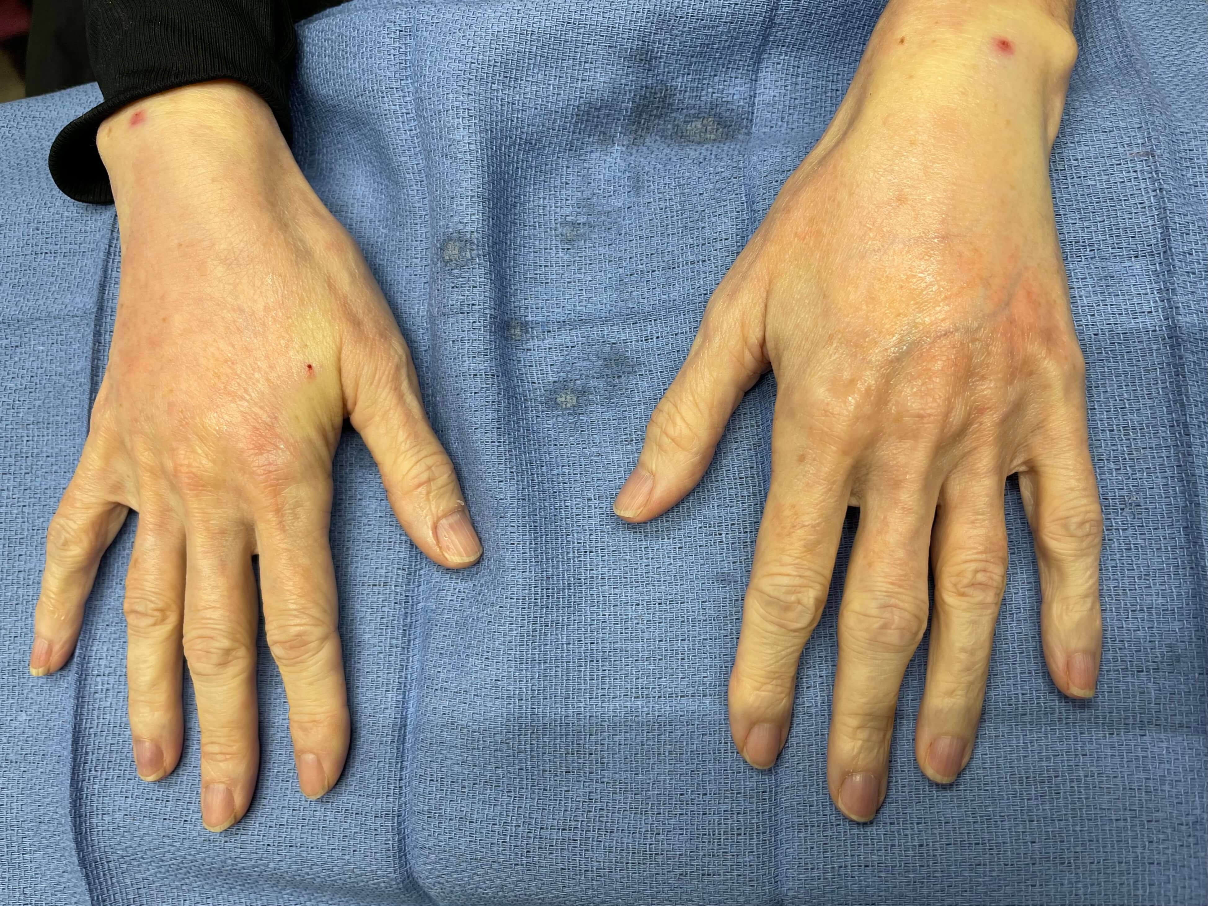 Side by side of fat to hands After