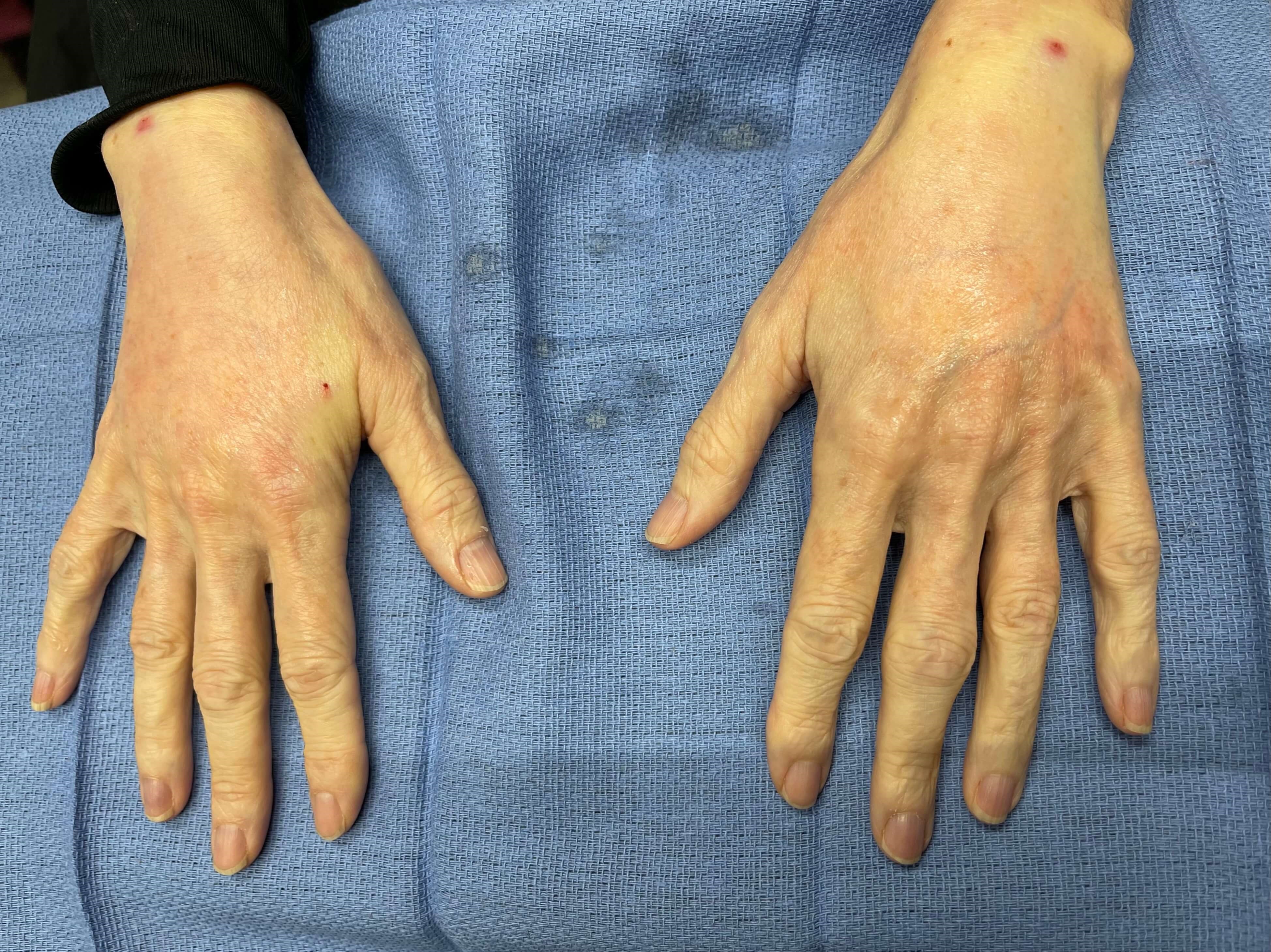 Side by side of fat to hands After