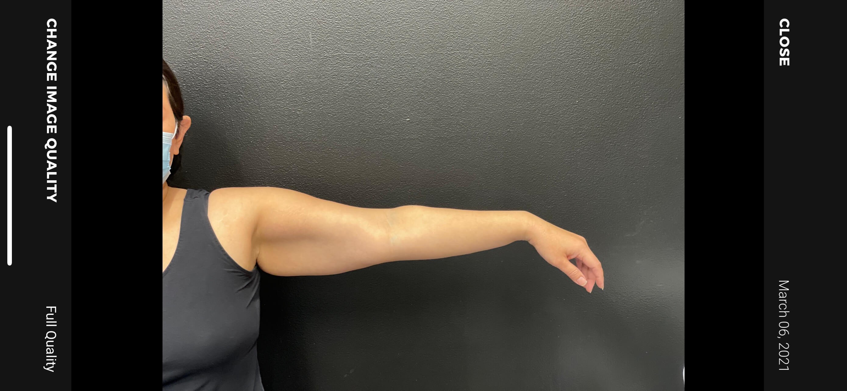 Arm Liposuction Before