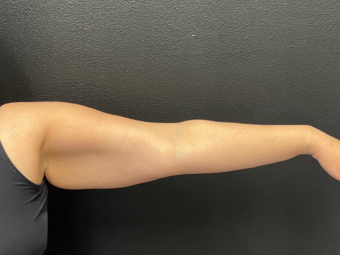 Arm Liposuction Before