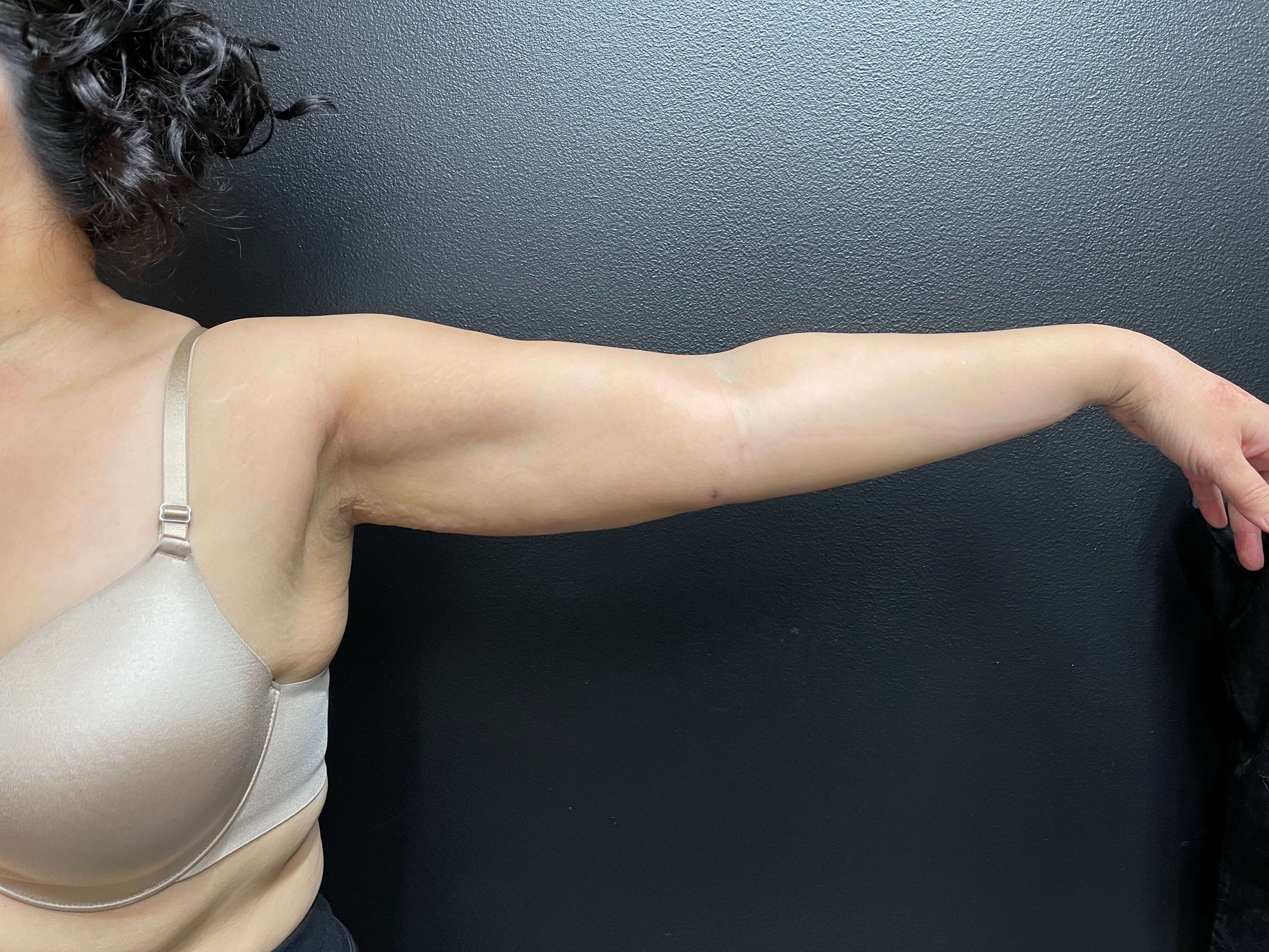 Arm Liposuction After 12 days