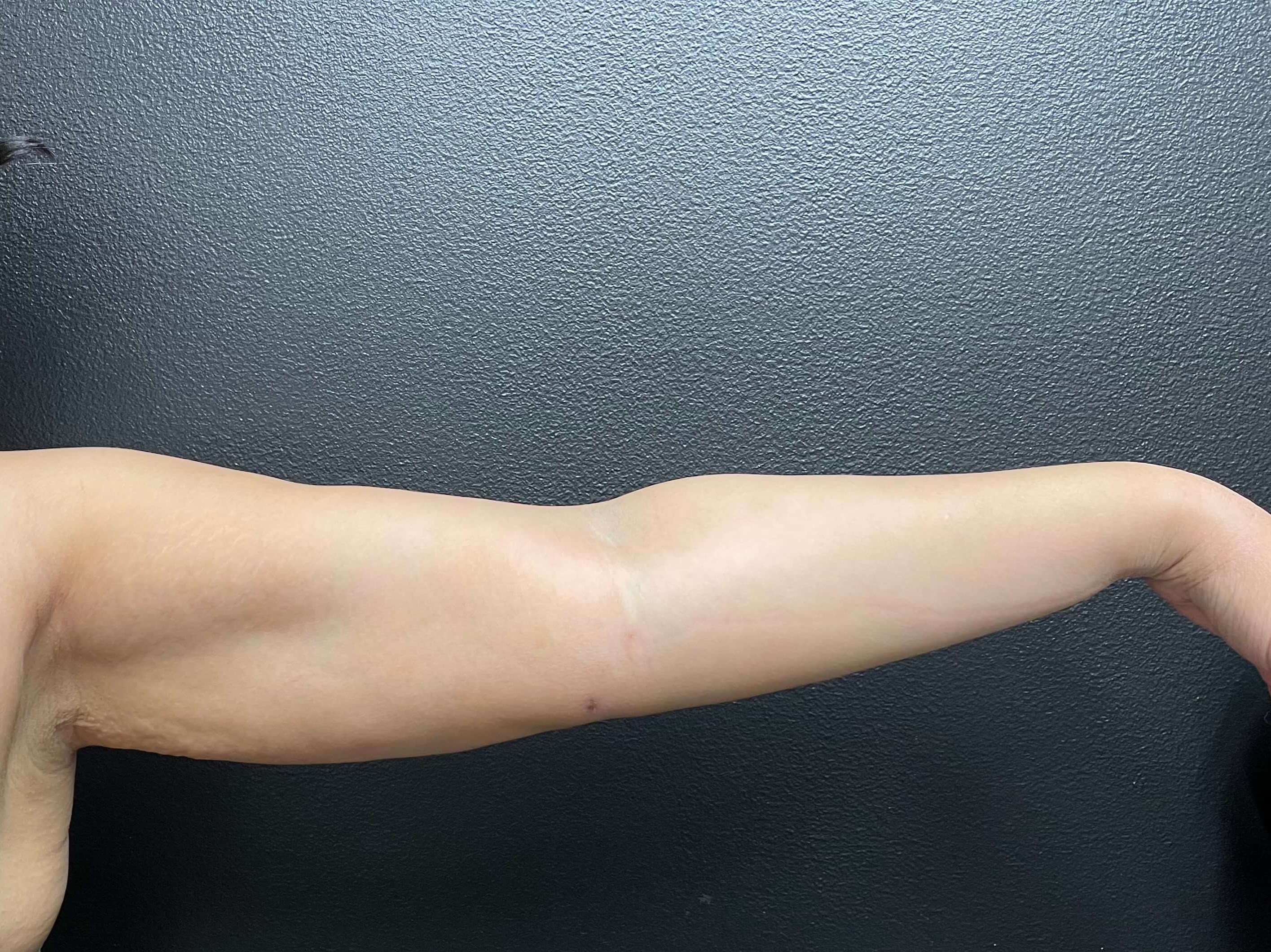 Arm Liposuction After 12 days