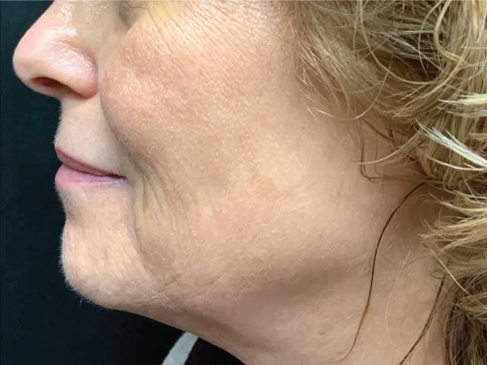 RF Pixel with PRP After