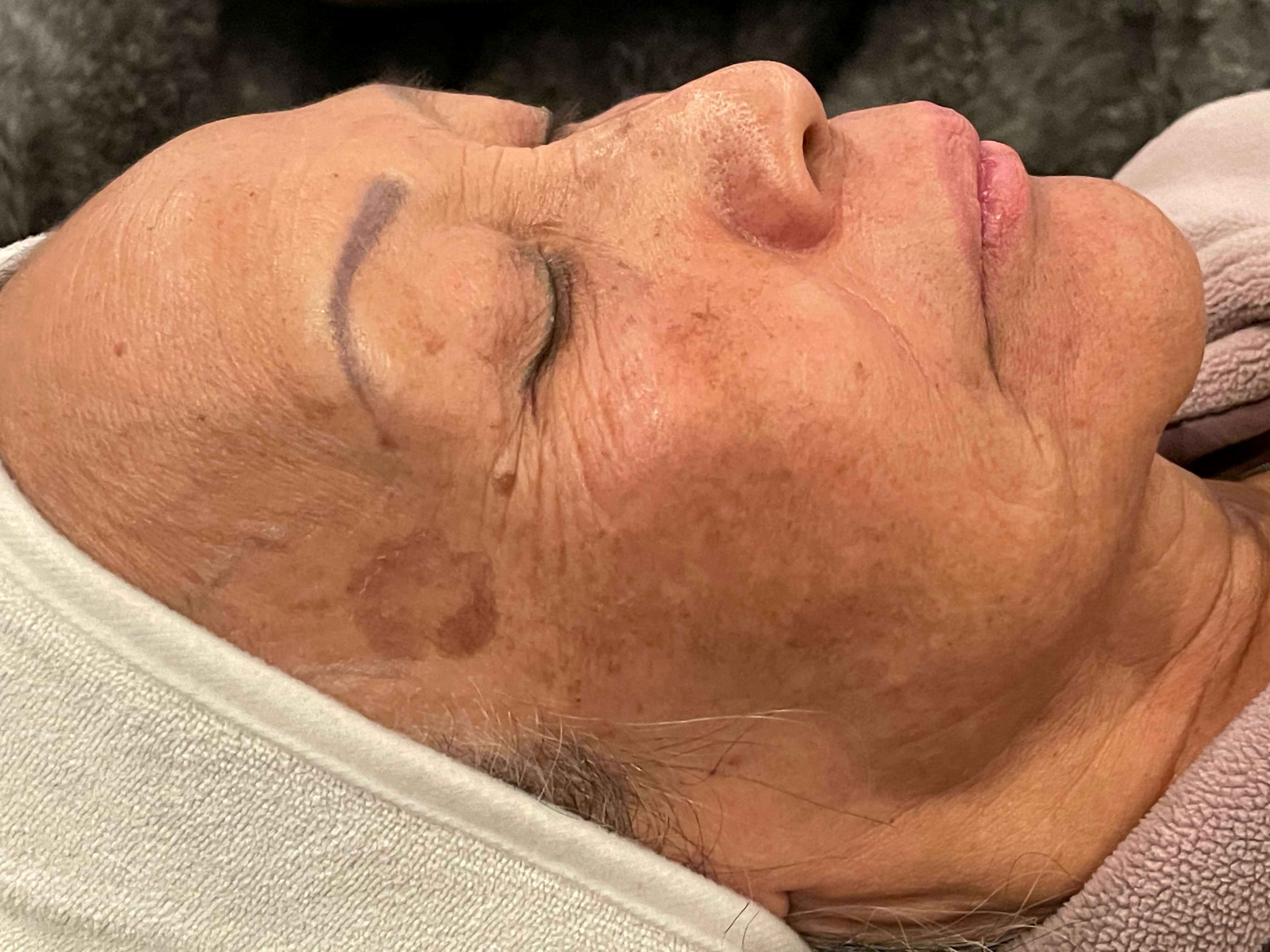 A solution for pigmentation Before