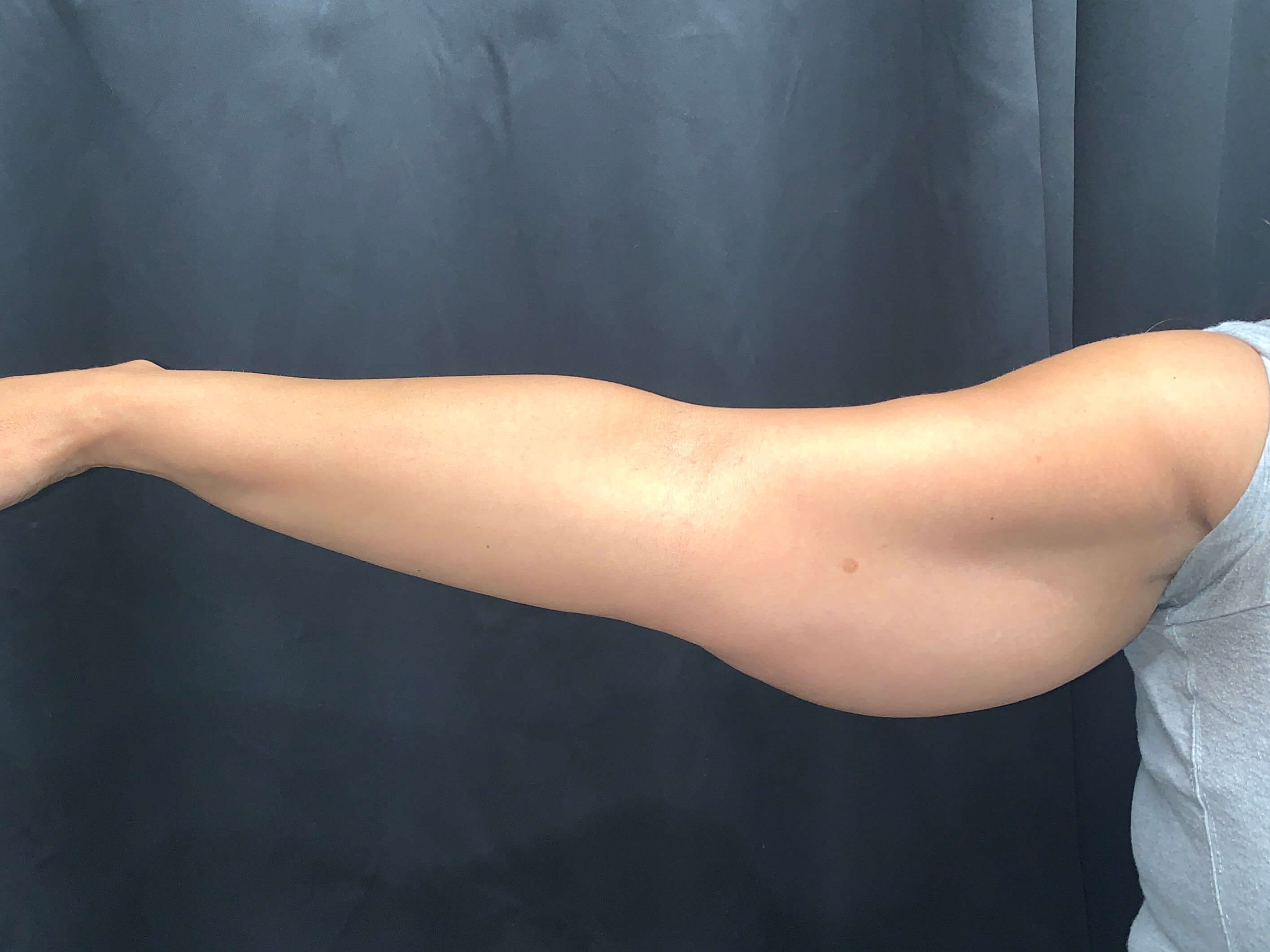 Arm Liposuction Before