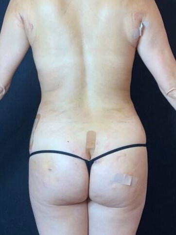 360 body sculpting After