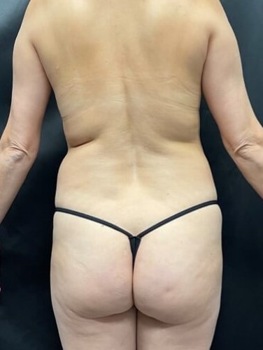 360 body sculpting Before