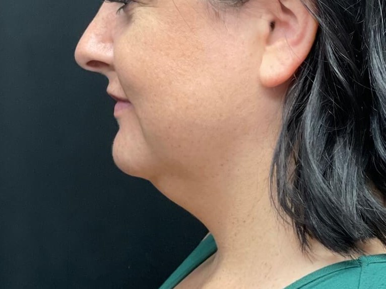 Chin and Jawline Laser Lipo Before