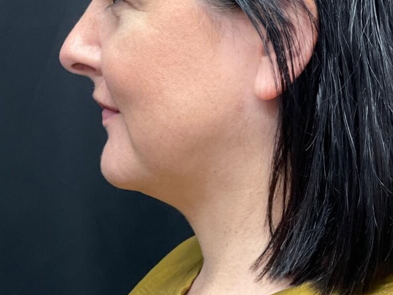 Chin and Jawline Laser Lipo After