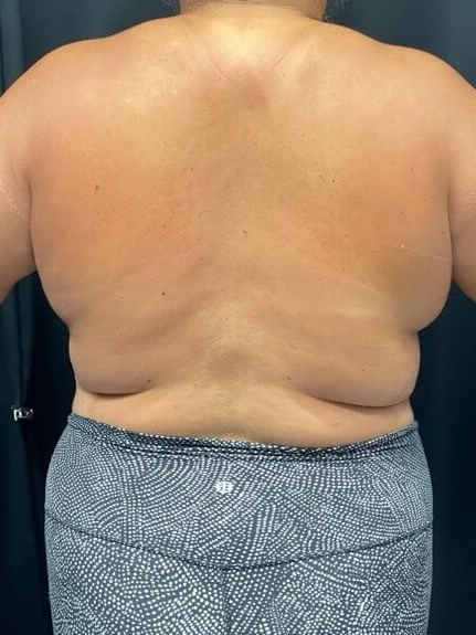 Upper Back Laser Lipo Before